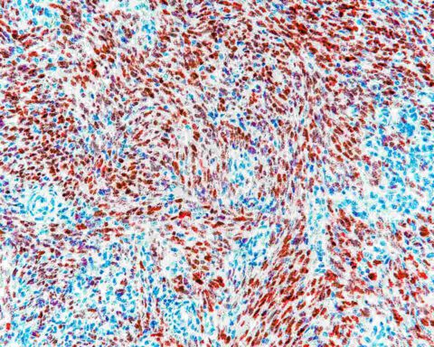 Microscopic image of Kaposi sarcoma tissue showing HHV-8 Latency-Associated Nuclear Antigen (LANA) expression with dark red stained nuclei and blue counterstained LANA-negative nuclei, displaying spindle cell formation in a pediatric lymph node sample.