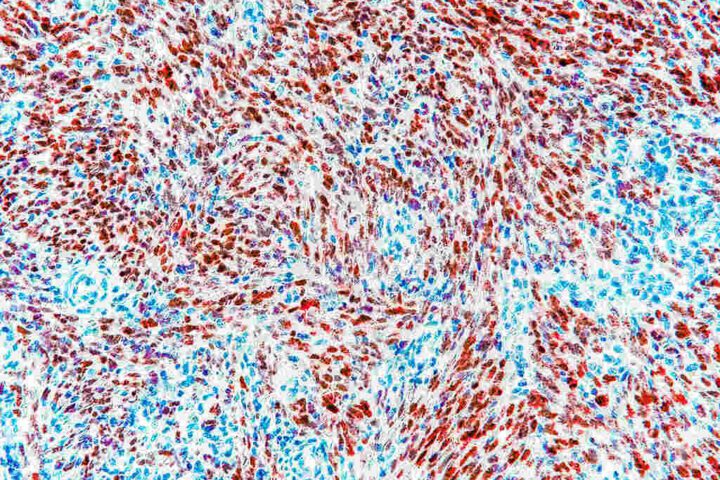 Microscopic image of Kaposi sarcoma tissue showing HHV-8 Latency-Associated Nuclear Antigen (LANA) expression with dark red stained nuclei and blue counterstained LANA-negative nuclei, displaying spindle cell formation in a pediatric lymph node sample.
