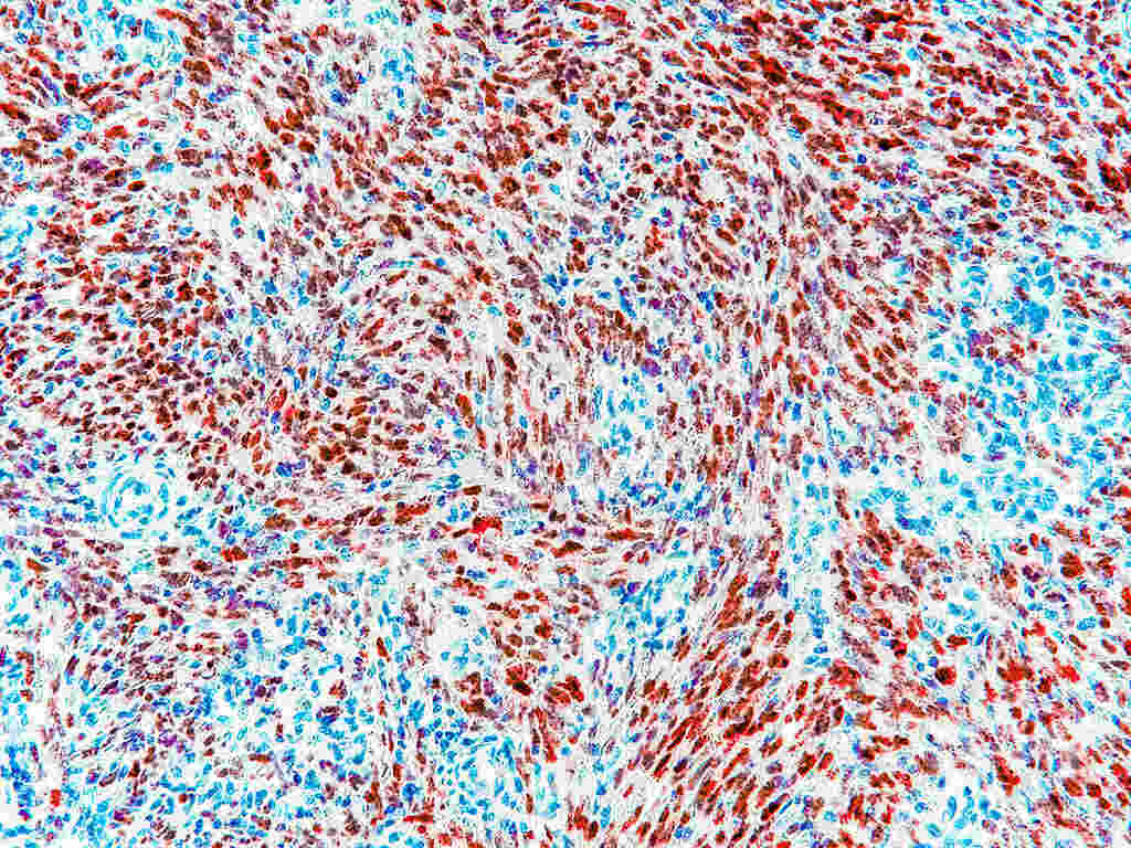 Microscopic image of Kaposi sarcoma tissue showing HHV-8 Latency-Associated Nuclear Antigen (LANA) expression with dark red stained nuclei and blue counterstained LANA-negative nuclei, displaying spindle cell formation in a pediatric lymph node sample.