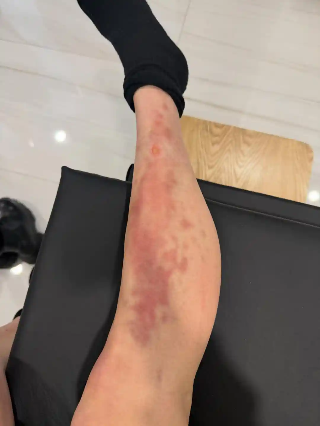 Close-up of Taylor Momsen's lower leg showing widespread redness and irritation after a reported venomous spider bite during her tour in Mexico City.