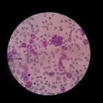 Osteopontin Protein Drives Cancer Metastasis—New Research Opens Therapeutic Targets