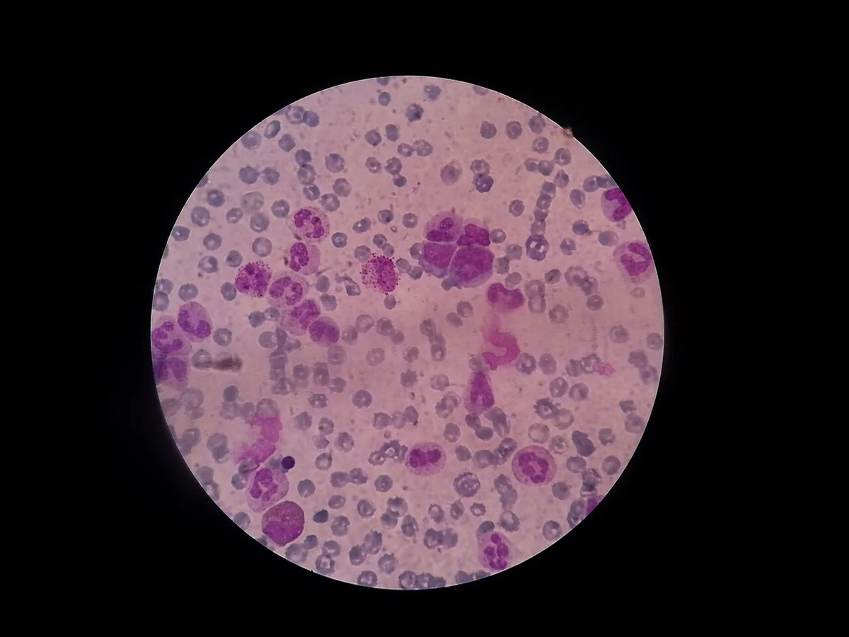 Microscopic view of leukemic blast cells in a blood smear.