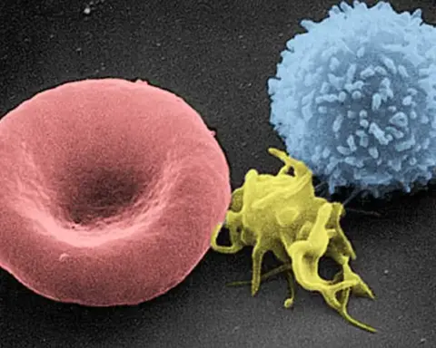 Red blood cells, a white blood cell and a platelet seen by scanning electron microscopy.