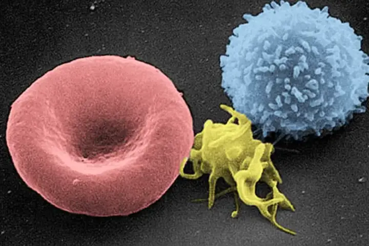 Red blood cells, a white blood cell and a platelet seen by scanning electron microscopy.