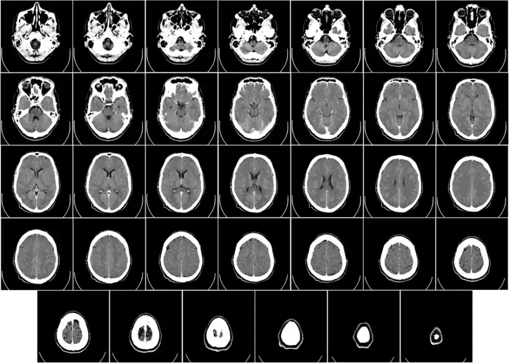 Lab-Grown Brain Tissue Matches Human Development Over Six Years