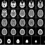 Lab-Grown Brain Tissue Matches Human Development Over Six Years