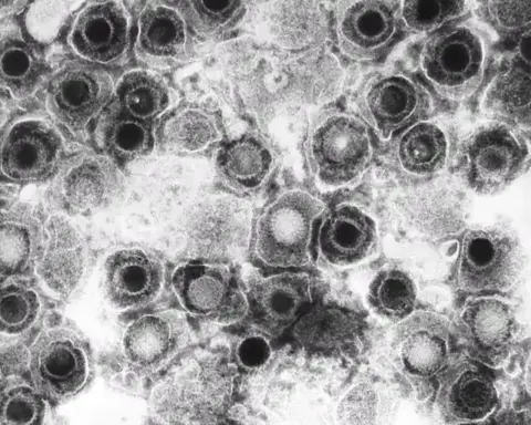 Herpesvirus particles seen by transmission electron microscopy, representing the dormant viruses COVID-19 can reactivate.