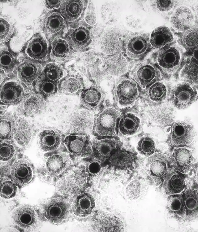 COVID-19 Awakens Dormant Viruses, and One Family Is Tied to Long COVID
