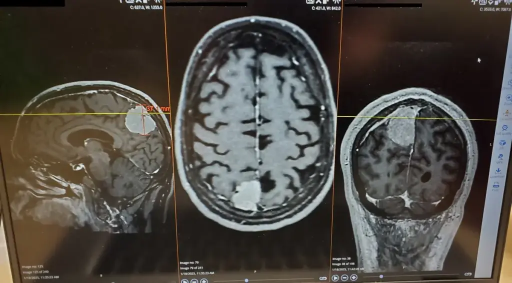 Busy Philipps Brain Tumor: MRI Screening Detected Grade 2 Oligodendroglioma, Recovery Without Chemotherapy