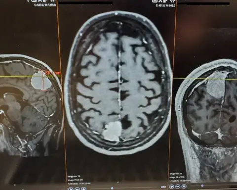 Medical illustration or MRI imaging showing brain anatomy, representing diagnostic imaging used in brain tumor detection and treatment planning.
