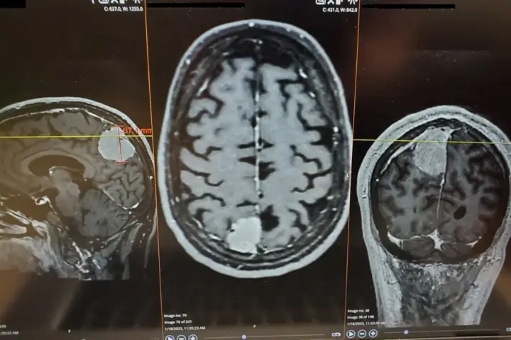 Medical illustration or MRI imaging showing brain anatomy, representing diagnostic imaging used in brain tumor detection and treatment planning.