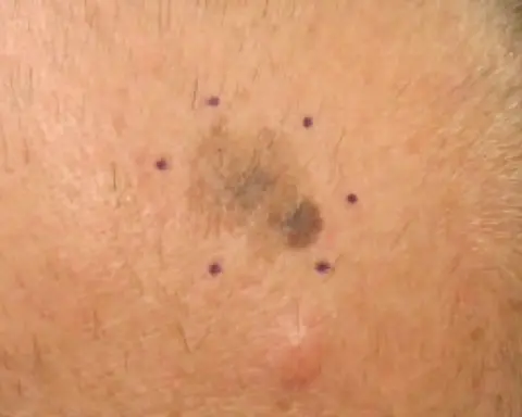 Close-up of a melanoma skin lesion marked for biopsy
