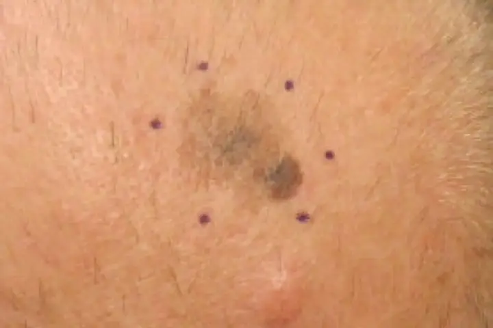 Close-up of a melanoma skin lesion marked for biopsy