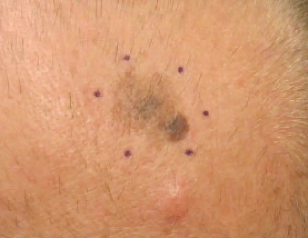 Moderna-Merck mRNA Cancer Vaccine Beats Keytruda Alone in Phase 3 Melanoma Trial
