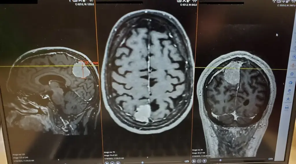 A brain MRI scan, the imaging technology now being paired with AI to detect aneurysms more accurately in radiology departments.