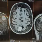 A brain MRI scan, the imaging technology now being paired with AI to detect aneurysms more accurately in radiology departments.