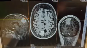A brain MRI scan, the imaging technology now being paired with AI to detect aneurysms more accurately in radiology departments.