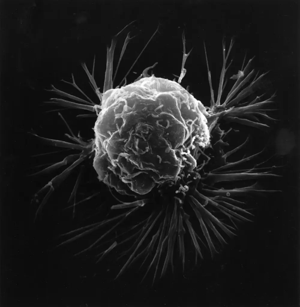 High-magnification scanning electron micrograph displaying the outer surface and irregular membrane of a human breast cancer cell.
