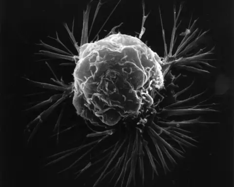 High-magnification scanning electron micrograph displaying the outer surface and irregular membrane of a human breast cancer cell.
