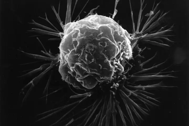 High-magnification scanning electron micrograph displaying the outer surface and irregular membrane of a human breast cancer cell.