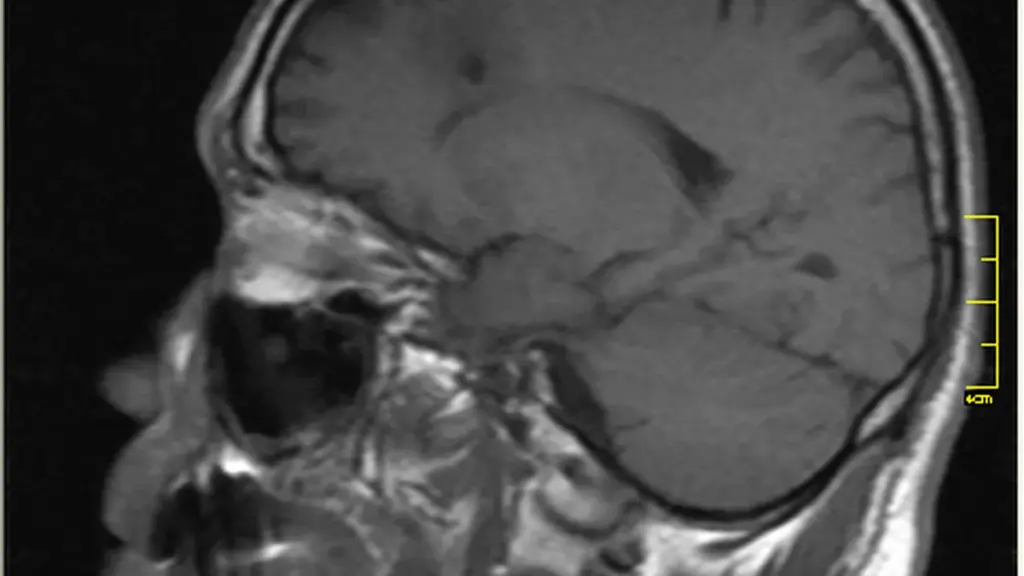 Cross-sectional MRI scan display showing the anatomical structure of the human cerebral cortex