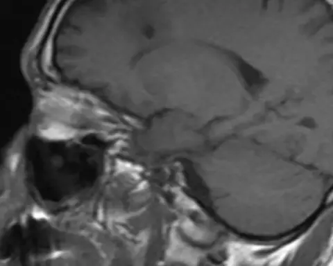 Cross-sectional MRI scan display showing the anatomical structure of the human cerebral cortex