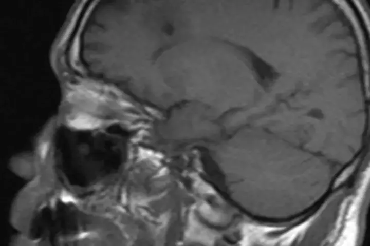 Cross-sectional MRI scan display showing the anatomical structure of the human cerebral cortex