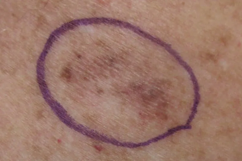Medical biopsy image representing cancer biomarker research and lung adenocarcinoma senescence scoring.