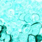 FDA Approves Daraxonrasib for Pancreatic Cancer — Survival Nearly Doubled, Cost Is ,800 a Month