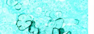 Microscopic view of human pancreatic cancer tumour cells