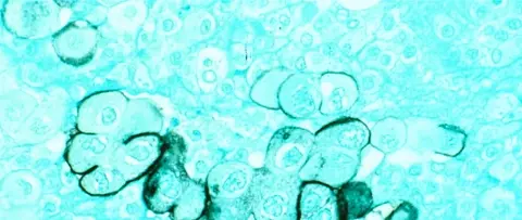 Microscopic view of human pancreatic cancer tumour cells