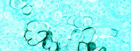 Microscopic view of human pancreatic cancer tumour cells