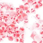 Microscope image showing Neisseria meningitidis bacteria stained in a clinical sample.