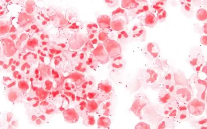 Microscope image showing Neisseria meningitidis bacteria stained in a clinical sample.