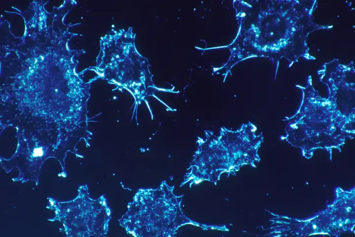 Cancer cells in tissue culture viewed under magnification