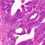 High-magnification microscope view of stained colorectal cancer tissue cells under laboratory evaluation.