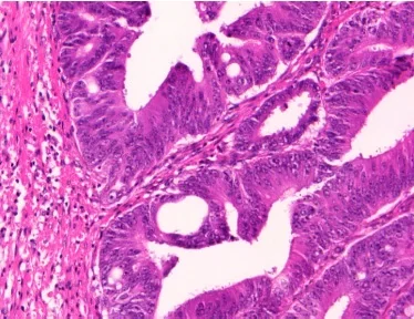 High-magnification microscope view of stained colorectal cancer tissue cells under laboratory evaluation.