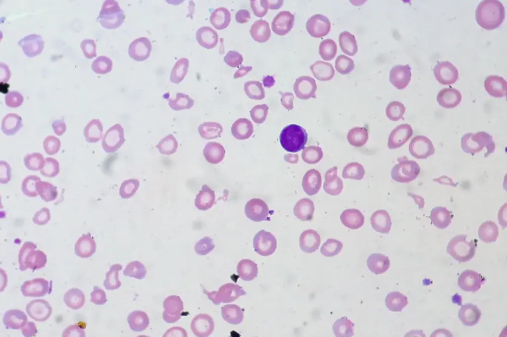 Microscopic view of red blood cells showing iron-deficiency anemia with small pale cells