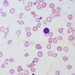 Microscopic view of red blood cells showing iron-deficiency anemia with small pale cells