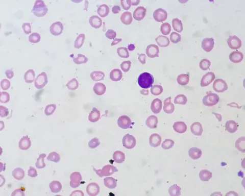 Microscopic view of red blood cells showing iron-deficiency anemia with small pale cells