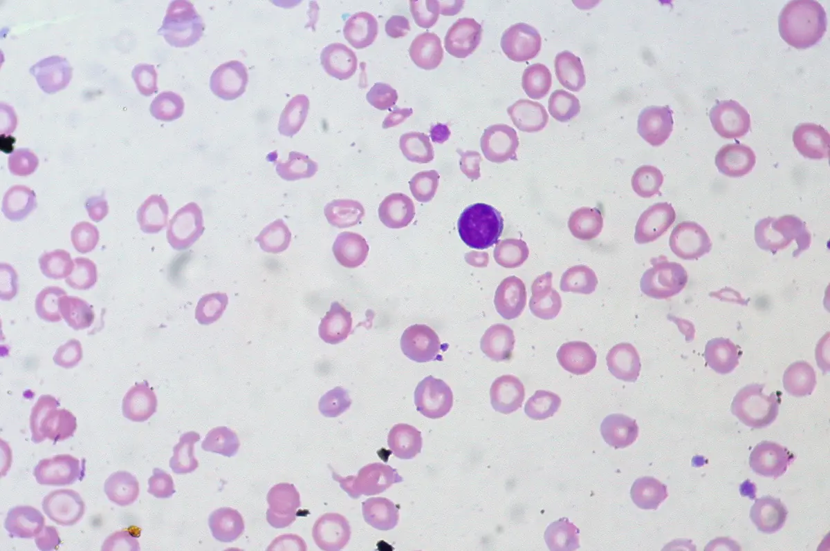 Microscopic view of red blood cells showing iron-deficiency anemia with small pale cells