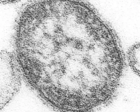 Microscopic view of the measles virus.