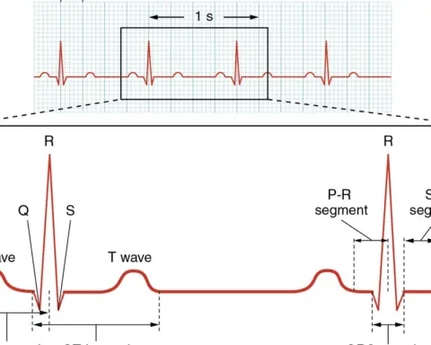 Close-up view of an electrocardiogram paper readout displaying cardiac rhythm waves and physiological voltage spikes.