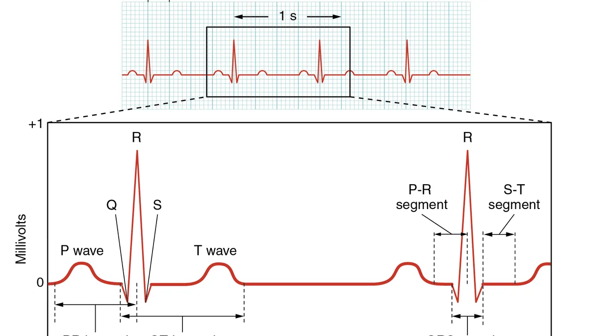 Close-up view of an electrocardiogram paper readout displaying cardiac rhythm waves and physiological voltage spikes.