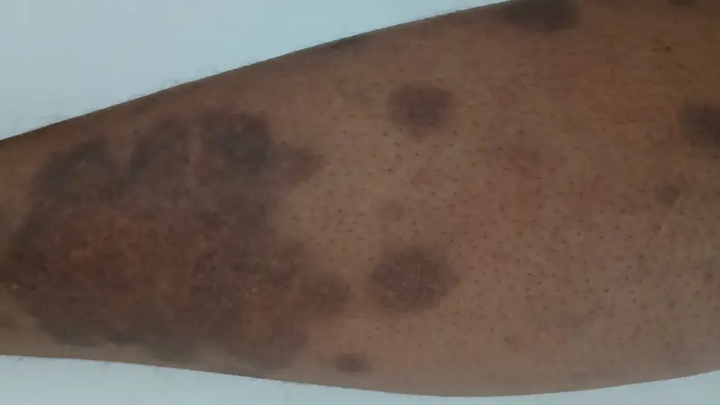 Close view of a skin condition on a person's leg.