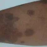 Close view of a skin condition on a person's leg.