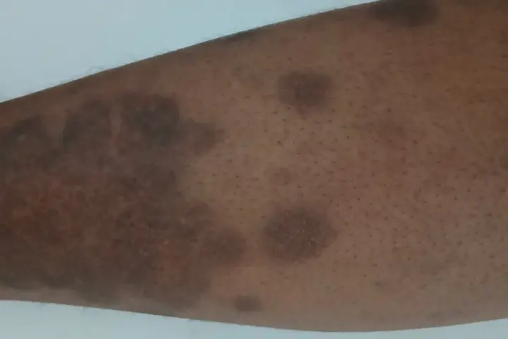 Close view of a skin condition on a person's leg.