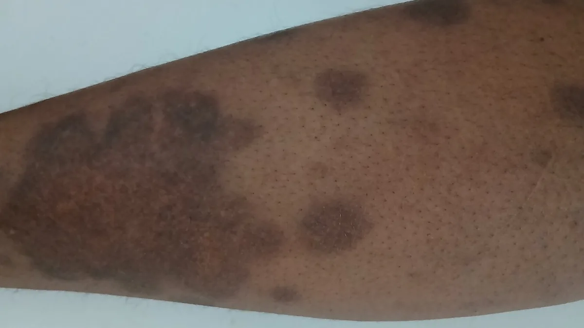 Close view of a skin condition on a person's leg.